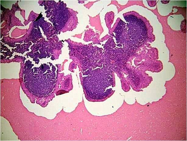 Warthin tumor - Eurocytology