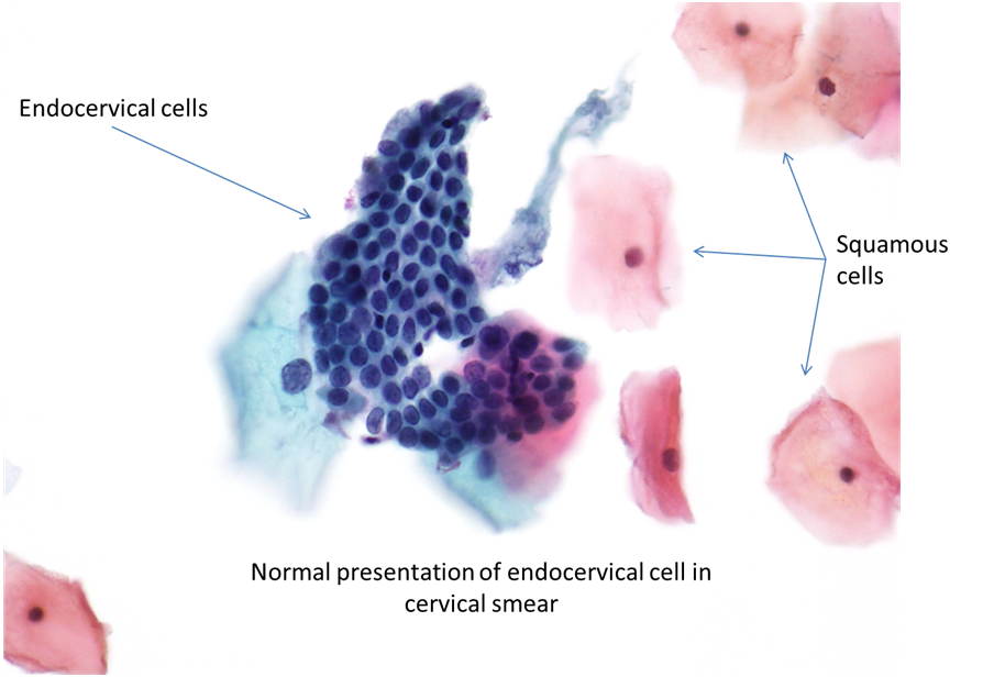 papanicolau normal y anormal