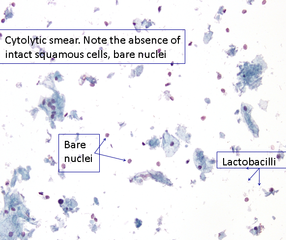 Sinonasalis papilloma onkocitikus típus | Gél Papillor