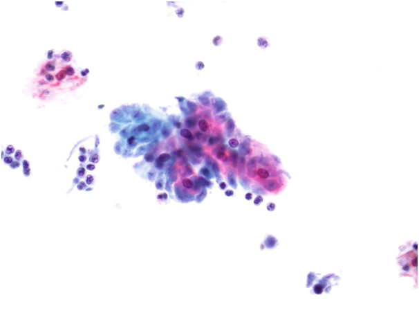 sinonazális papilloma onkocitikus típus condylom szaga
