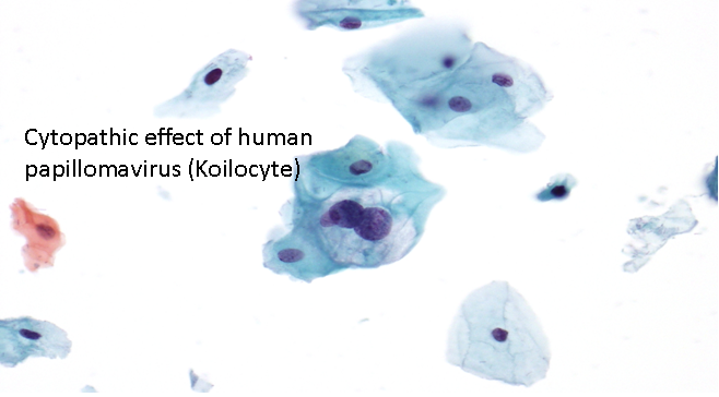 sinonazális papilloma onkocitikus típus