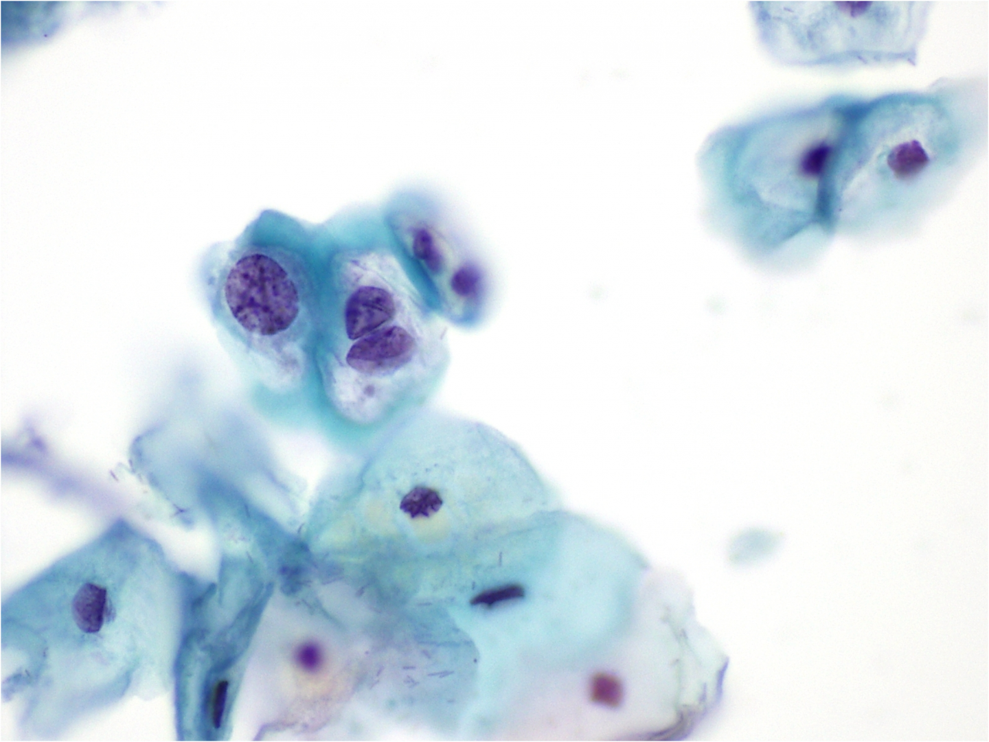 Leziune Intraepiteliala Scuamoasa De Grad Scazut Anomaliile celulelor scuamoase ale colului uterin | Eurocytology