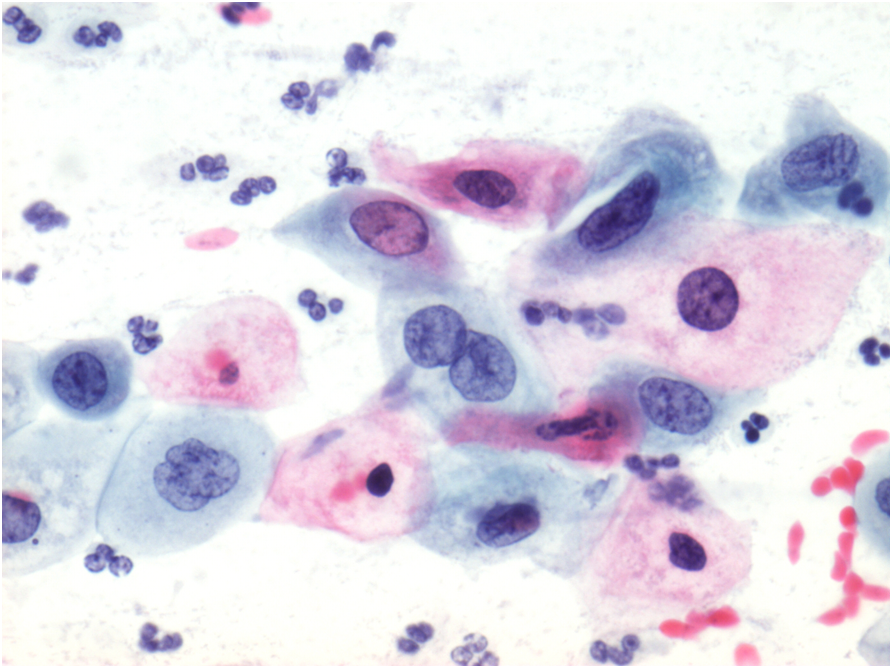 Плоский эпителий в цитограмме. Жидкостная цитология LSIL.
