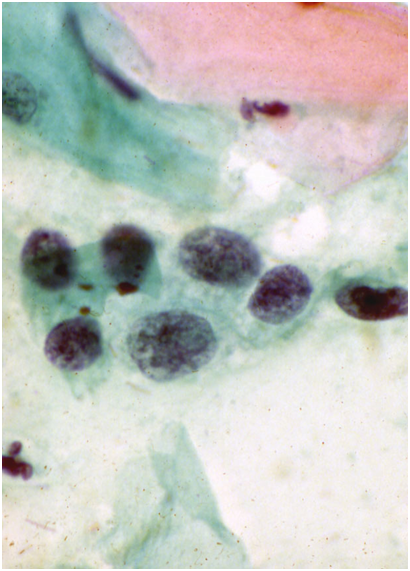 Atypical Squamous Cells Cannot Exclude Hsil Asc H Eurocytology