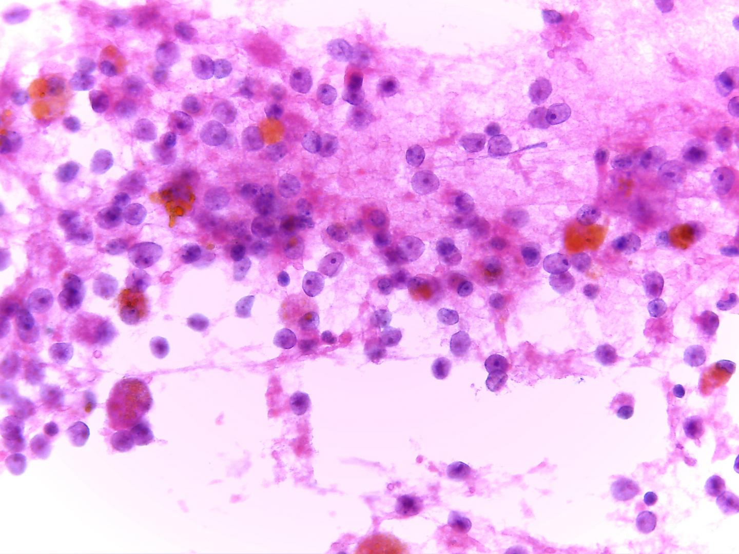 Renal cell carcinoma (RCC) - Eurocytology