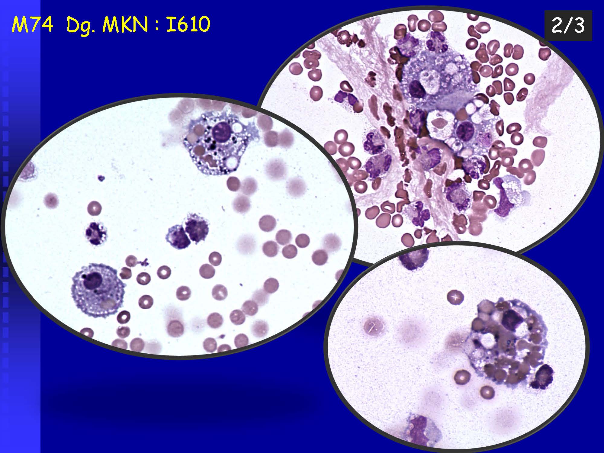 Cytology of the Cerebrospinal fluid - part II_Pagina_04