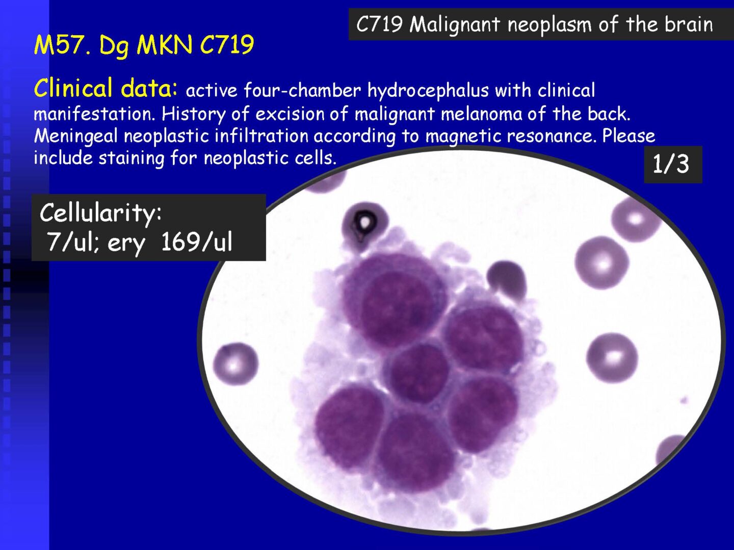 Cytology of the Cerebrospinal fluid - part II_Pagina_31